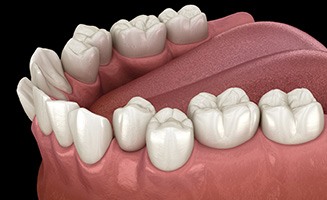 Illustration of crooked teeth