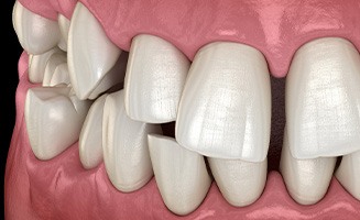 Illustration of gapped teeth