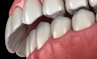 Illustration of an overbite