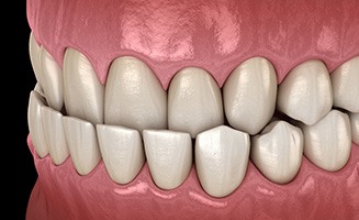 Illustration of an underbite