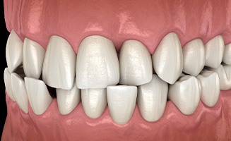Illustration of a crossbite