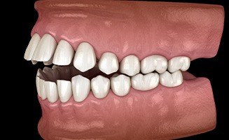 Illustration of an open bite