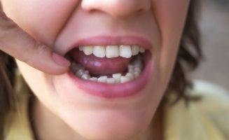 close up of person pointing to their crooked lower teeth