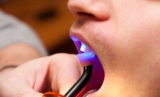 Close up of dental patient getting their teeth treated with dental bonding