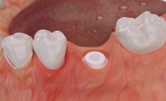 Close up of animated mini dental implant in between two natural teeth