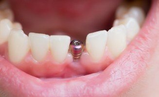 Close up of smile with visible dental implant abutment