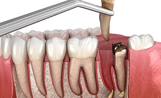 Extraction of a cracked tooth