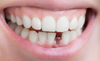 Close up of a patient’s smile revealing a dental implant