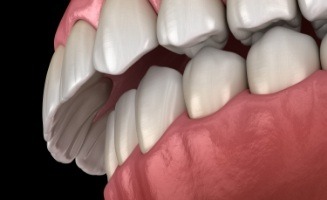Close up of animated overbite
