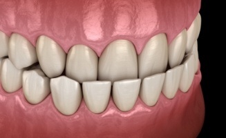 Animated teeth with underbite