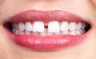 Close up of smile with gap between two front teeth