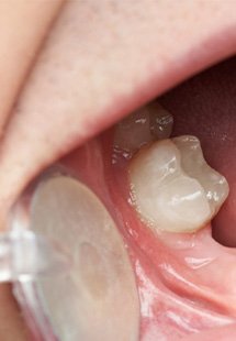 patient with missing tooth visiting dentist 