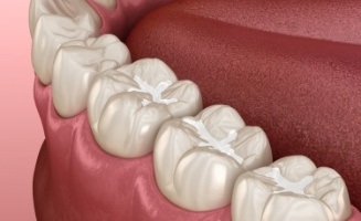 Animated row of teeth with dental sealants