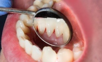 Close up of dental mirror inside of mouth