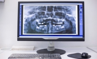 Computer screen showing an x ray of teeth