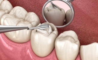 Animate close up of dental filling being placed in tooth