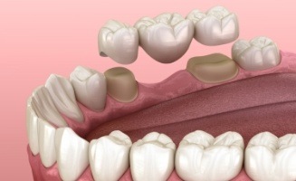 Animated dental bridge replacing a missing tooth