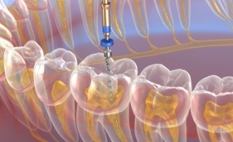 Animated dental instrument performing root canal treatment on the inside of a tooth