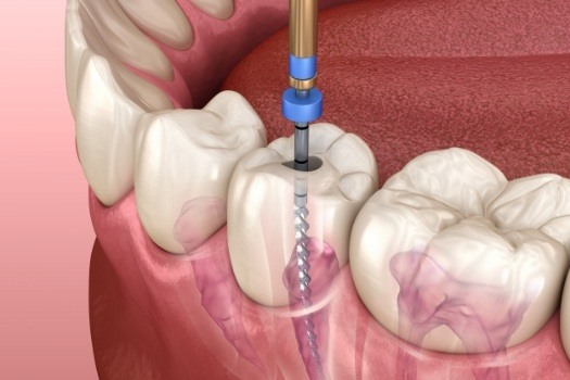 Animated dental instrument performing root canal treatment on inside of tooth