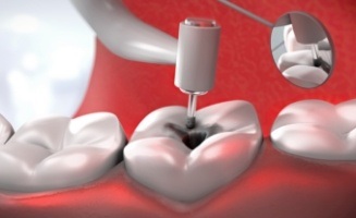 Animated dental instrument treating the inside of a tooth