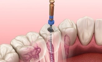 Animated dental instrument cleaning the inside of a tooth