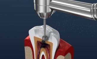 Animated dental instrument filling the inside of a tooth during root canal treatment