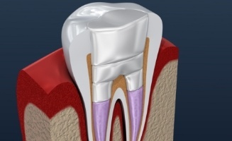 Animated tooth with a filling after root canal treatment