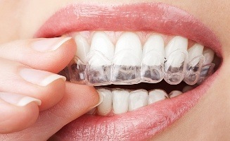 Close up of person placing teeth whitening tray in their mouth