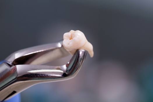 Dental forceps holding a tooth after tooth extractions in Edison