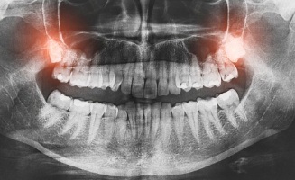 X ray of teeth with the wisdom teeth highlighted red