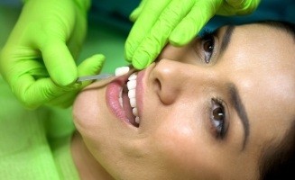 Dentist placing a veneer over a woman's tooth
