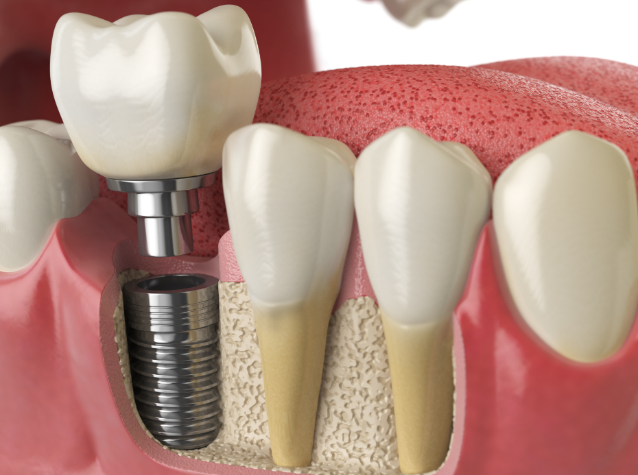 3D image of a dental implant