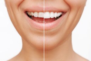 Nose-to-neck closeup of someone smiling with teeth half covered in veneers